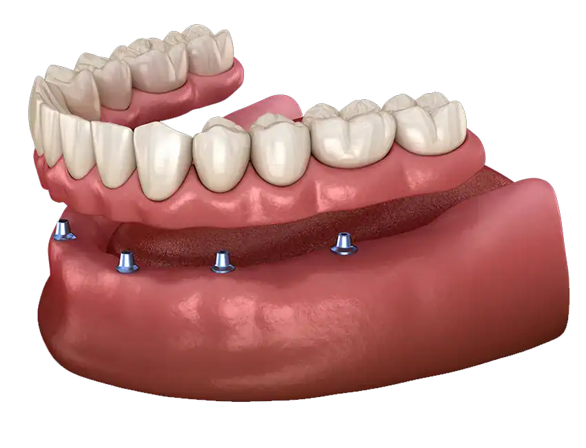 How Overdentures Attach to Dental Implants
