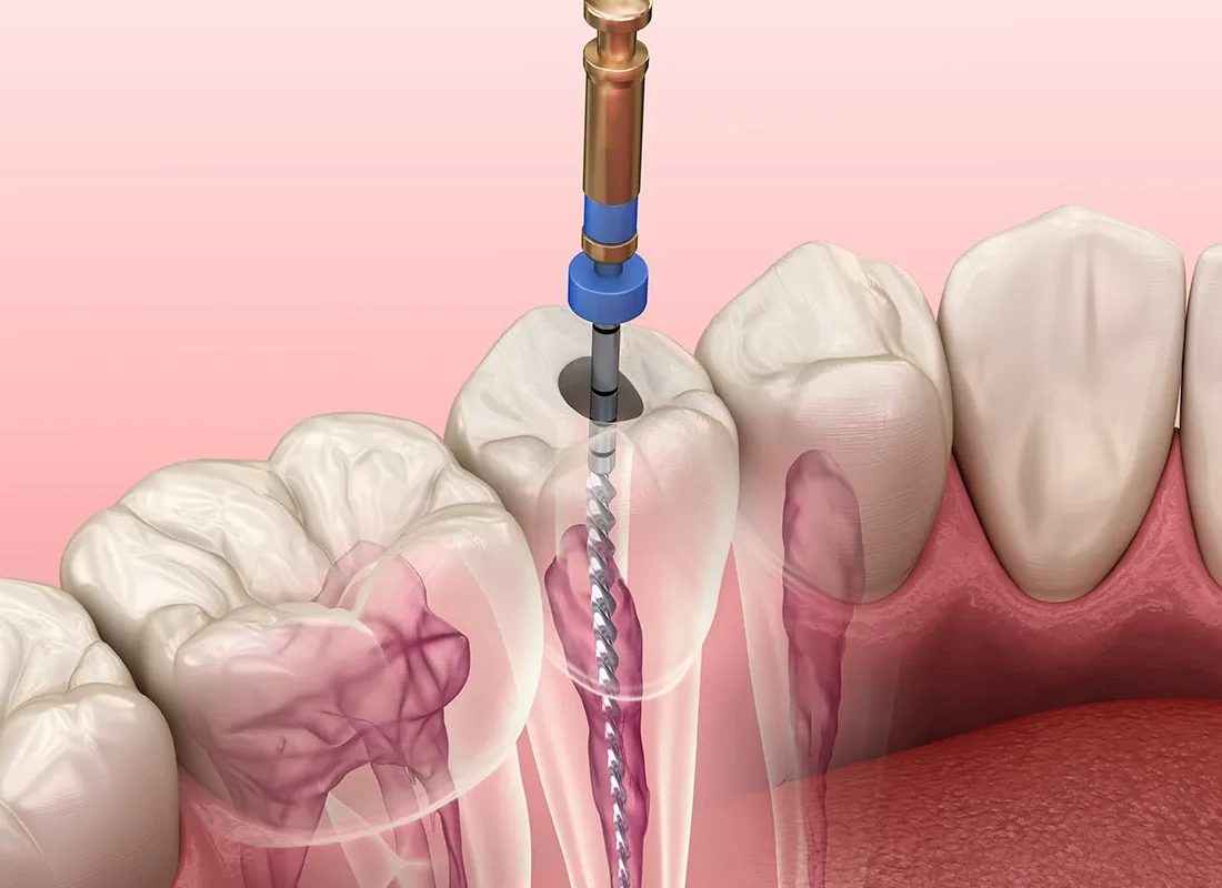 What is Root Canals