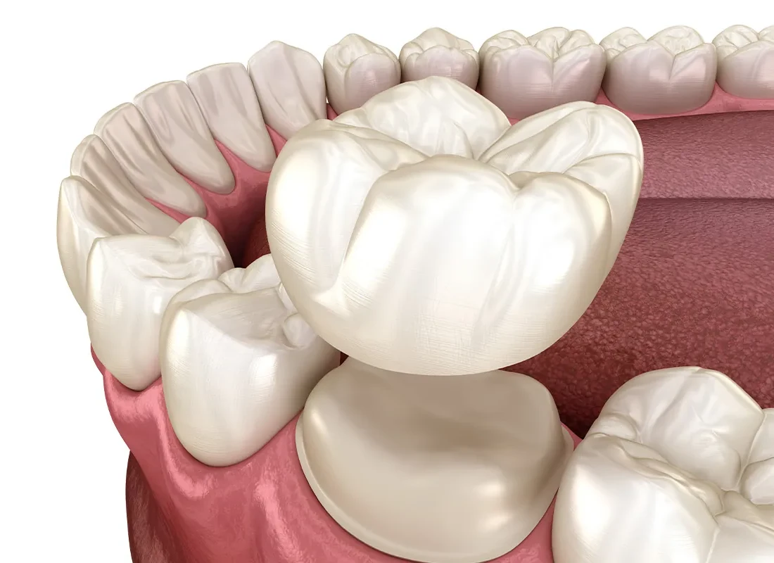 How Do Dental Crowns & Bridges Work? Everything You Need to Know