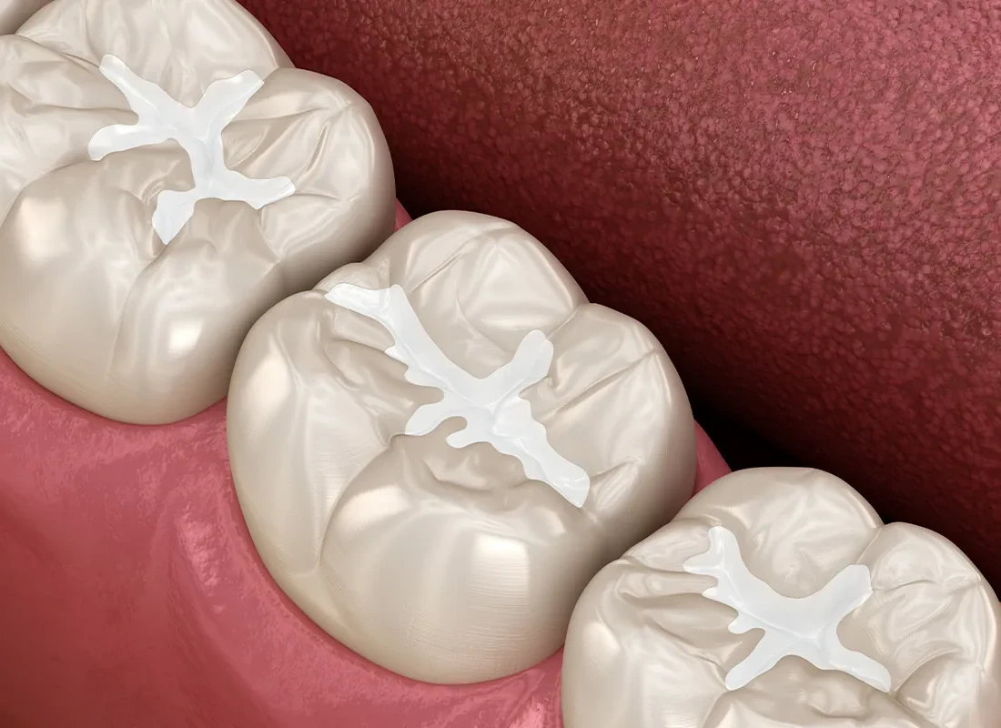 What is Composite Tooth-Colored Fillings