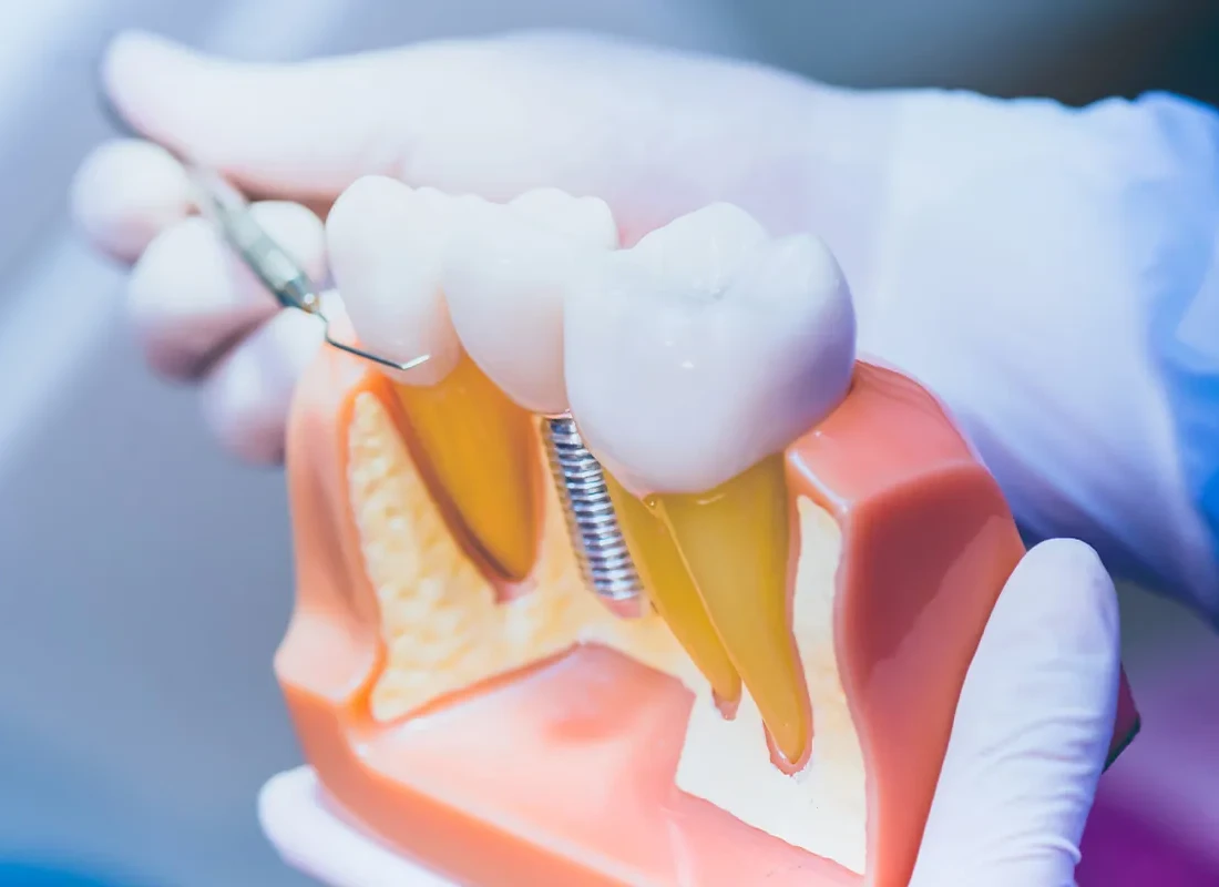 How Dental Implants Fit into Full Mouth Reconstruction