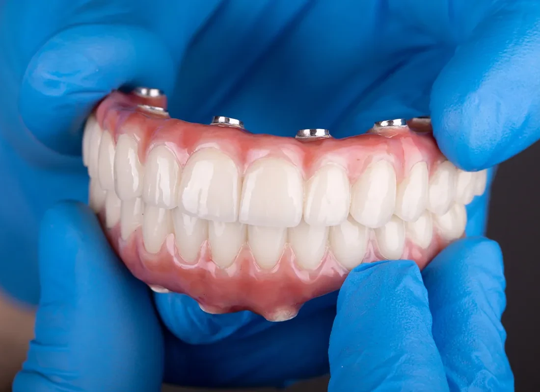 The Science Behind Implant-Supported Overdentures
