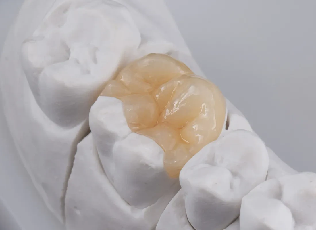 How to Care for Dental Inlays and Onlays for Long-Lasting Results