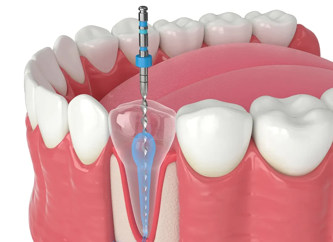 The Role of Endodontists in Root Canal Treatment