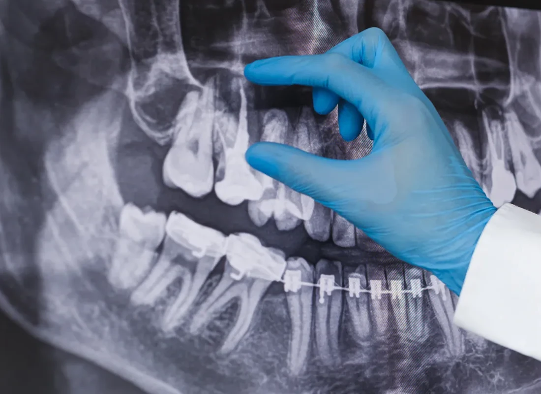 Root Canals