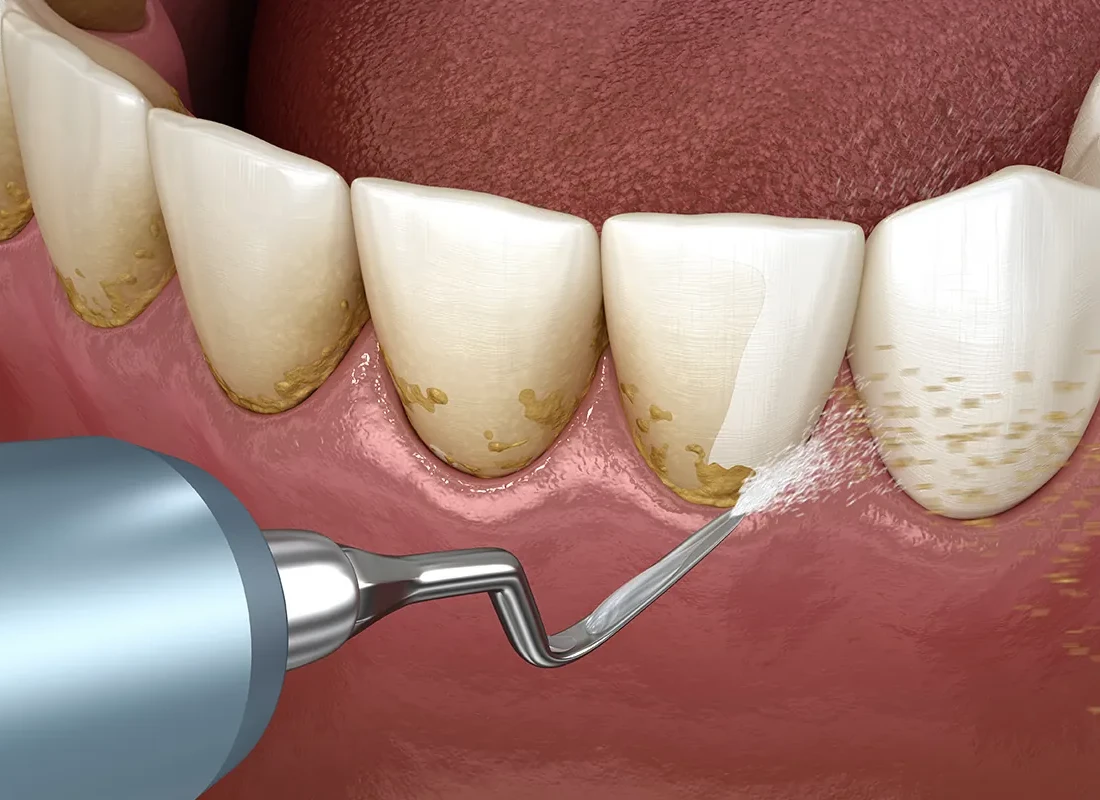 What is Dental Cleaning & Consultation